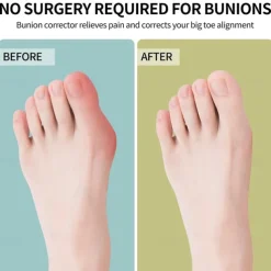 Bunion Corrector for Women amp Men 2 in 1 Adjustable Big Toe Relief Bunion Splints Hammer Toe Straightener Comfortable Effective Double Correction 1 set