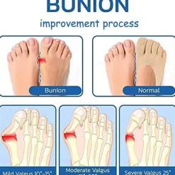 Orthoes Bunion Relief Socks Women - Orthopedic Toe Compression Sock - Projoint Antibunions Health Sock - Sock Align Toe Socks for Bunion - Anti Bunion Socks for Women and Men