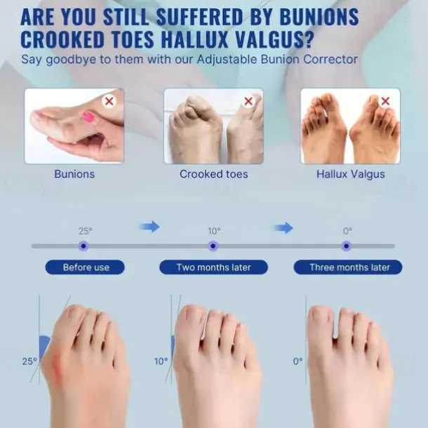 Toe Separator For Bunion Relief, (Fit Up To 100kg) Bunion Corrector For Women And Men Big Toe Pain Relief Set, Day & Night 24hrs Support Big Toe Straightener, Big Toe Hammer Bunion